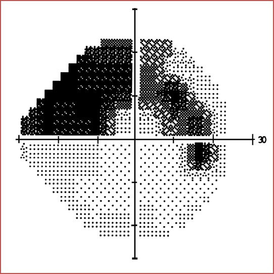 Champ visuel glaucome