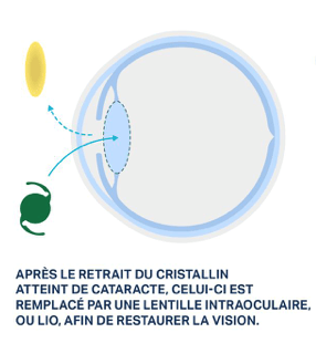 Comment se déroule la chirurgie de la cataracte