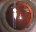 Comment se déroule la chirurgie de la cataracte