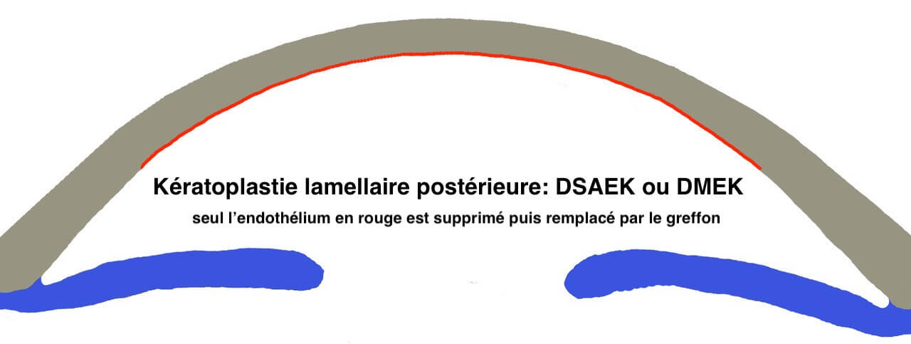 La keratoplastie lamellaire postérieure