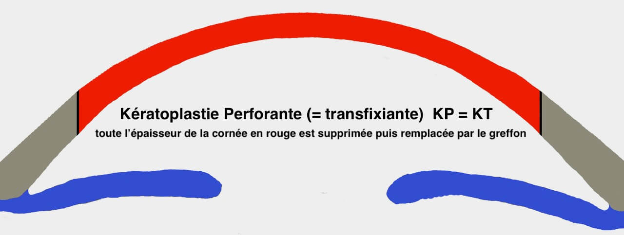 La Keratoplastie perforante