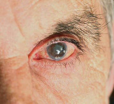 Glaucome : pourquoi un dépistage précoce est essentiel pour préserver la vision